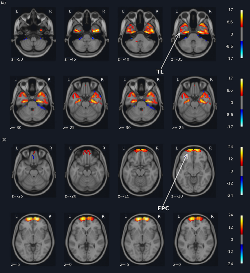 Axial brain slices showing two independent component networks: one centred on the temporal lobes, one on frontopolar cortex.